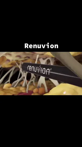 O Renuvion é uma tecnologia de radiofrequência e plasma que promove a contração dos tecidos, tratando a flacidez da pele. #renuvion #renuvionjplasma #renuvionbrasil 