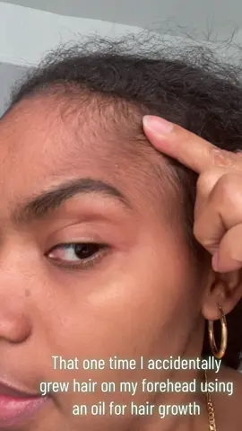 #Postpartum #Hairloss is real. So I started using this oil on my edges and didn’t realize oil was also running down my forehead and made me hairy 😅
