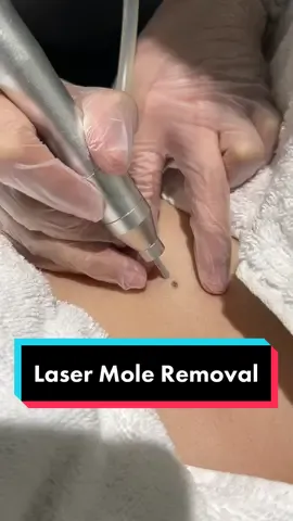 To safely, effectively and permanently clear away unwanted flat moles, #MannyAndPieCalayanClinic offers LASER MOLE REMOVAL. Book now through our website! #moles #flatmoles #moleremoval #moleremovaltreatment 
