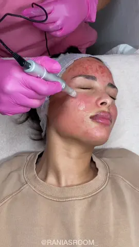 Le temps idéal pour le microneedling est arrivé ❄️ !  Vous ne savez pas ce qu’est le microneedling ? Le microneedling est le traitement miracle pour les rides, les taches, les pores dilatés et les peaux ternes. Il s’agit d’un traitement qui va stimuler la production de collagène grâce à des micro-aiguilles qui piquent dans le derme de la peau. Le derme est la couche où le collagène est généré. Je conseille vraiment ce traitement a tout le monde pour un petit coup de boost.  Alors qu’attendez-vous pour réserver ? ✨  #soinmicroneedling #microneedling #facialinbrussels #facialsbrussels #facialsinbrussels #brussels #glowingskin #fyp #skincare #skintok #facials #soinvisage #conseilsbeaute 