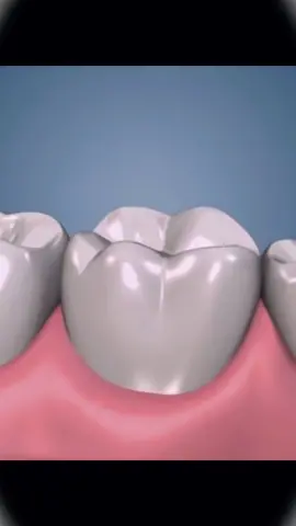 Dental Implant Procedure #3danimation #medicine #fyp 