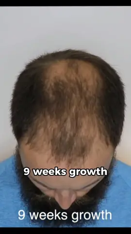 Step By Step Headshave *SATISFYING* #stepbystep #baldcafe #bald #balding #malepatternbaldness #headshave #cleanshave #inspire #motivate #selfconfidence #SelfImprovement #transformation #headshave #masculinity