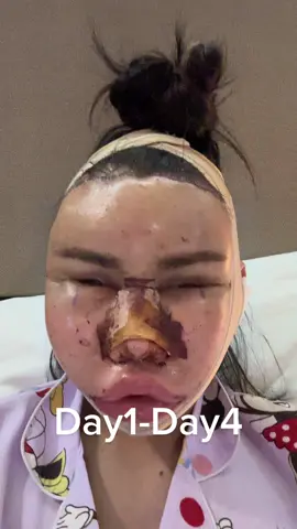 ลืมตา หุบปากแทบไม่ได้ ใครจะมาทำศัลกรรมเกาหลี เตรียมความพร้อมเตรียมร่างกายมาดีๆน๊าา #ศัลยกรรมเปลี่ยนชีวิต #ศัลยกรรมเกาหลี #เกาหลีเกาใจ💕🇹🇭🇰🇷 #ศัลยกรรมโครงหน้าเกาหลี #สวยชาตินี้ไม่รอชาติหน้า 