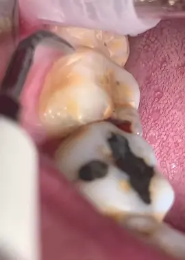 Igiene dentale tramite strumento ad ultrasuoni. Grossi accumuli di tartaro. #dentist #dentista #scaling #tartaros_team  🪥🦷🚿