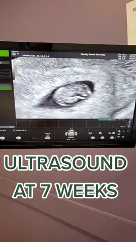Our sweet miracle ✨️  I'll share the details later on today! #7weekspregnant #7weekultrasound #ultrasound #firsttrimester #highriskpregnancy #pregnancyupdate #pregnancyjourney #pregnancyafterloss #pregnancyaftermiscarriage