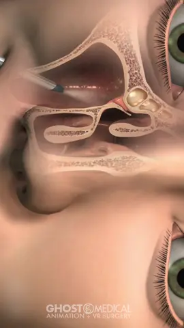 FinESS™ is the maxillary and anterior ethmoid sinus dilation treatment that allows patients with challenging nasal anatomy to be treated safely, simply and effectively in the office. #congestion #medicalanimation  #surgerytiktok #processvideo #awareness 
