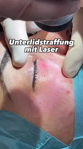Schreibt mir eure Fragen auf Instagram per DM 📬 #ehrenarzt #beautydoc #schönheitschirurgie  #co2laser 