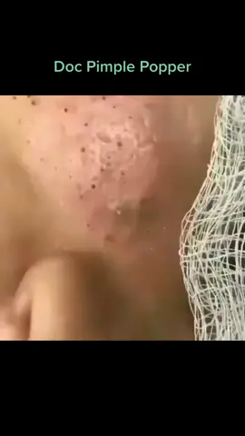 Blackhead Removal From Face #pimple #acne #pimples #blackheads #pimplepopping #skincare #blackhead #pimplepopper #whiteheads #pimplepoppers #whitehead #blackheadextraction #blackheadremoval #cyst #pimplepop #drpimplepopper #pimplesremover #zit #pores #skin #whiteheadextraction #drsandralee #beauty #acnetreatment #cystremoval #zits #whiteheadremoval #jerawat #skincareroutine #pimpleremover