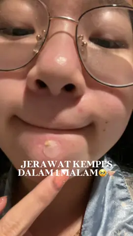 bener bener ya acne patch tu sengaruh itu!! apalagi kalau besoknya ada event biar muka rata tanpa jerawat bengkak😤😤