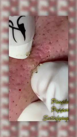 Acne Treatment PART 2 I Daily Satisfying Acne, Whiteheads and Ingrown Hair #fyp