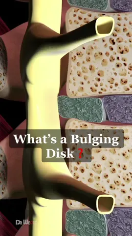 What Is A Bulging Disk #3d #animation #spinehealth #bulgingdisc 