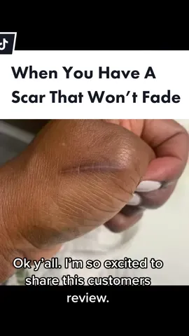 Our Morning Moringa Scar butter is the truth. It fades, reduces and improves the appearance and texture of surgical scars or any scars. #scarring #darkscars #melanatedskin #fadescars #skincare #blackgirltiktok #SelfCare #skincareroutine #skincaretips 