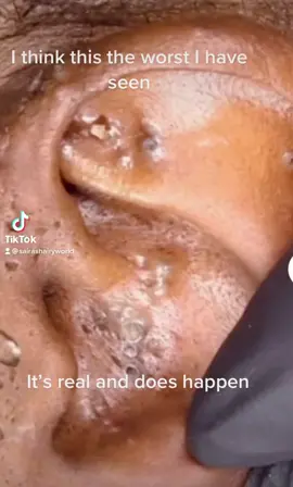 #hygiene #skinproblem #extractions #earextraction #whiteheads #viralvideo #foryoupage 