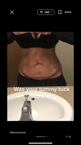 Carrying twins ruined my body. The confidence this surgery gave me… it’s been a few years ago now, but such big changes #surgery #cosmeticsurgery #nojudment #selfworth 