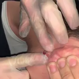 Behind The Ear Pop #pimple #acne #pimples #blackheads #pimplepopping #skincare #blackhead #pimplepopper #whiteheads #pimplepoppers #whitehead #blackheadextraction #blackheadremoval #cyst #pimplepop #drpimplepopper #pimplesremover #zit #pores #skin #whiteheadextraction #drsandralee #beauty #acnetreatment #cystremoval #zits #whiteheadremoval #jerawat #skincareroutine #pimpleremover