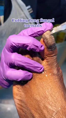 Cutting long, thick toenails with fungus by foot specialist 🦶 #podiatry #footspecialist #toenails #fungus #fungaltoenails #podiatristoftiktok #trustyourpodiatrist  #beforeandafter #satisfyingvideo #fyp  #viral 