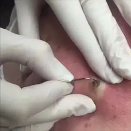 Seems like it never ends  #pimple #acne #pimples #blackheads #pimplepopping #skincare #blackhead #pimplepopper #whiteheads #pimplepoppers #whitehead #blackheadextraction #blackheadremoval #cyst #pimplepop #drpimplepopper #pimplesremover #zit #pores #skin #whiteheadextraction #drsandralee #beauty #acnetreatment #cystremoval #zits #whiteheadremoval #jerawat #skincareroutine #pimpleremover