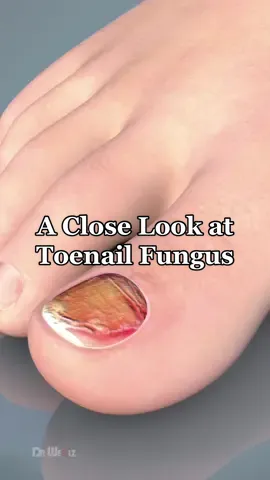 A Close Look at Toenail Fungus #3d #animation #toenailfungus #footfungus 