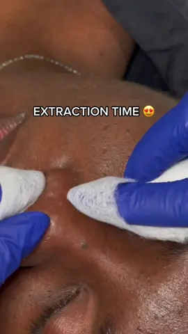 Extractions, sometimes uncomfortable but ✨necessary✨ before continuing on with other services 💕  #extractions #extractionstoronto #satisfyingextractions #thedermabar 