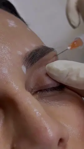 Você conhece a técnica do A invertido? É uma técnica avançada consiste em preencher com ácido hialurônico para suavizar a sensação de olho profundo. Agende sua consulta com uma de nossas dermatos para avaliação ✨ #preenchimento #dermatologist 