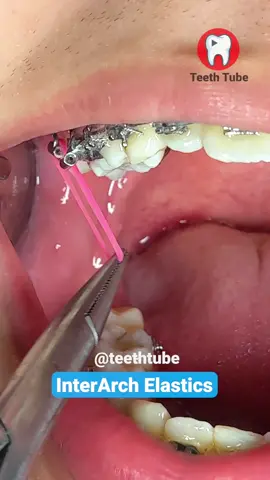 InterArch Elastics #braceselastics #braces #interarchelastics #dentist #teethtube 