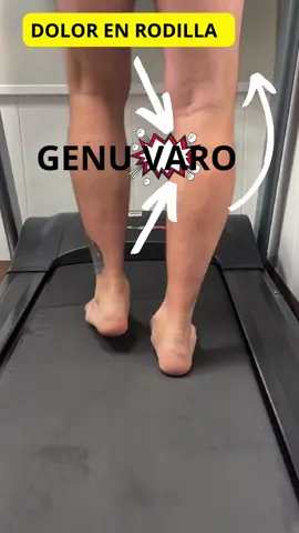 ⚠️Si tus rodilla se van hacia fuera cuando andas,  o tienes las piernas arqueadas 🏇 y tienes dolor en la cara interna de la rodilla, con plantillas a medida lograrás tener menos dolor 😀. ¿Cómo? Modificando los vectores de fuerza que viajan del suelo hacia arriba y aliviando la compresión de la cara interna de la rodilla. #rodilla #biomecanica #kneepain #especialistasenpie 