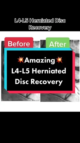 DM on IG to learn more: prime_spine_wellness #fyp #l4l5discherniation #nosurgery  #primespinewellness #bethesdamaryland