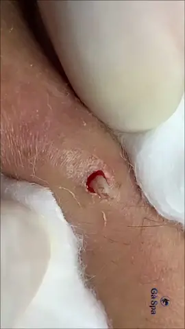 Cyst Extraction | wait till the end #pureskinbeautyspa #beautyclub #fyp #cystremoval #cystextraction #cystpopping 