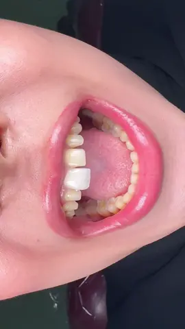 Laminate Veneers by Oval Dental Clinic