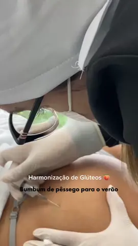 Harmonização de glúteo com Sculptra 🍑 #tiktok #bioestimuladordecolageno #harmonizaçãodegluteos #sculptra #influencer 