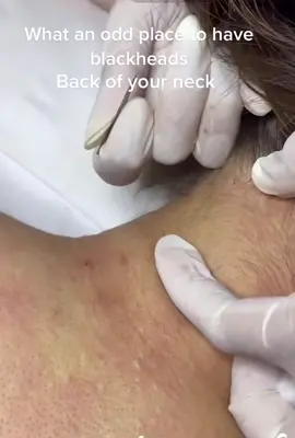 Never do this before.  #neckblackhead #whiteheads #blackheadsremoval #extraction #viralvideo #foryoupage 