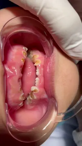 Bé bị sún nguyên hàm răng - xử lý thế nào?