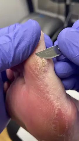 Thick painful dry cracked big toe hard skin (callus) removed with scalpel by Australian podiatrist #callus #corn #podiatrist #australia #ergonx #docpods #satisfying 