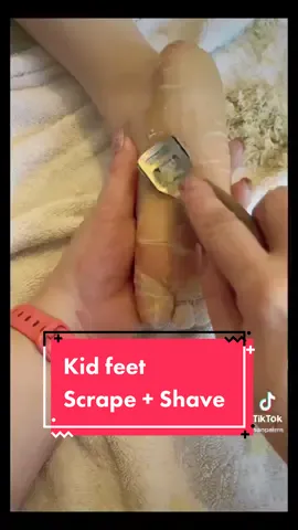 Trying this again because ppl have been triggered ‼️🥰 #palmoplantarkeratoderma #callousremover #callousshaver #callousremoval #rareskincondition #eppk #parmeseanpalms #geneticmutation #geneticdisease #raredisease #rarediseaseawareness #callousedfeet #callousedfoot #footcalus @parmesanpalms 