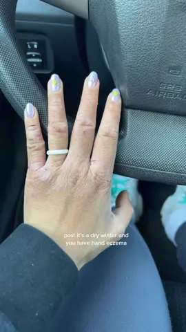 OUCH #eczema #eczemaflareup #eczemacheck #eczematiktok #eczemawarrior #eczemacommunity #eczemasurvivor #drywinter #drywinterskin #dryskin #relatable 