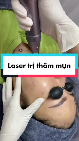 Nhả vía cho những ai đang thâm mụn tùm lum #xulybeauty #skincare #mụn #dcgr #laser #trimun 