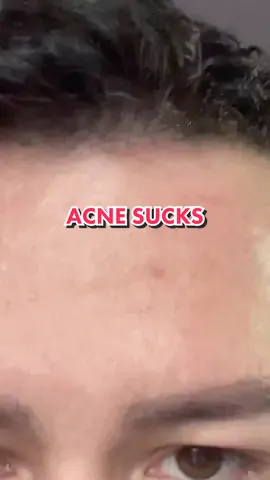 I still am very self conscious about my skin. I tried just about everything! High school sucked so much for me, but I learned to control what I can. The doctors gave me so much medication and they don’t work after awhile. So this is my helpful tip for acne on a budget! #ancesucks #pimples #facecarehacks 