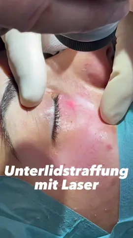 Hallo 🙋🏻‍♂️ Da ich eine Vielzahl von Nachrichten bekommen, würde ich dich bitten, mir auf meinem Instagram-Account @raphael_weiland zu schreiben. Alternativ kannst du auch direkt einen Termin über unsere Onlineterminvergabe machen: https://s-thetic.de/beratungsgespraech