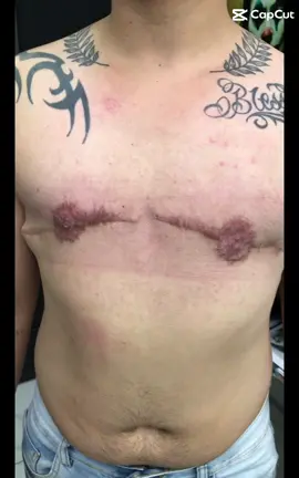 Cobertura de cicatriz!  #tattoo #tatuagem #cobertura #coberturacicatriz #cicatriz #antesedepois  