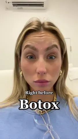 No wrinkles for me 👍🏼🤞🏼 #botox #xeomin #umiami 