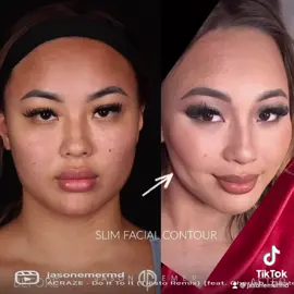 Buccal fat removal🔪