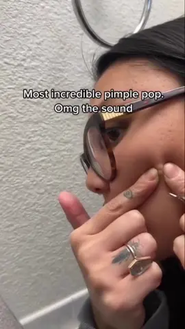 Pimple pop #pimple #acne #pimples #blackheads #pimplepopping #skincare #blackhead #pimplepopper #whiteheads #pimplepoppers #whitehead #blackheadextraction #blackheadremoval #cyst #pimplepop #drpimplepopper #pimplesremover #zit #pores #skin #whiteheadextraction #drsandralee #beauty #acnetreatment #cystremoval #zits #whiteheadremoval #jerawat #skincareroutine #pimpleremover
