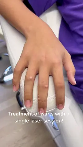Treatment of warts👌✨ Credit: @oasis.med ✨ #warts #fingerwarts #laser #removalwarts #handwarts #skincare 
