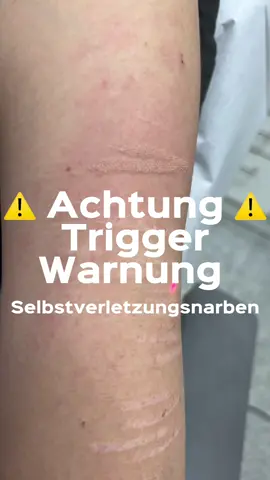 🇩🇪Sendet eure Fragen zur Narbenkorrektur per DM 📨 🇬🇧Send your questions about scar reduction via DM 📨 #ehrenarzt #beautydoc #schönheitschirurgie #narben #narbenbehandlung 