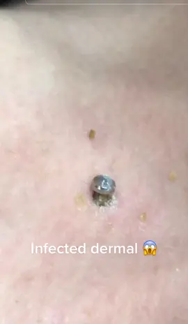 #infectedimplant #dermalgonewrong #badpiercing #latuerta #dermalpiercing #viralvideo #fyp 