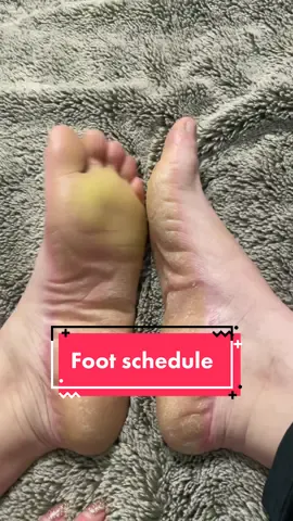 Replying to @ebony_scorpio 🥰 I completely shave my feet down every 2.5 to 3 months and do maintenance in between to prevent cracking and stay comfortable 😁 my hands I shave every two weeks consistently, regardless of thickness or comfort 😅  I don’t soak/scrape my hands, I just keep them very thin always ##callousremoval##callous##callousedfeet##callousedfoot##footcallus##footcallusremover##parmeseanpalms##eppk##dermatologytiktok##palmoplantarkeratoderma##epidermolytichyperkeratosis##geneticmutation##rareskincondition##ppkawareness##geneticdisease##raredisease##rarediseaseawareness