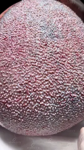 Cabelos prontos pra crescer. ❤️. #fy #foryou #stanleyshair #transplantecapilar #fue #estetica #cirurgia #calvice #cabelo #capilar #tratamento #pravoce 