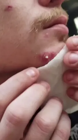 Big pimple pop #pimple #acne #pimples #blackheads #pimplepopping #skincare #blackhead #pimplepopper #whiteheads #pimplepoppers #whitehead #blackheadextraction #blackheadremoval #cyst #pimplepop #drpimplepopper #pimplesremover #zit #pores #skin #whiteheadextraction #drsandralee #beauty #acnetreatment #cystremoval #zits #whiteheadremoval #jerawat #skincareroutine #pimpleremover