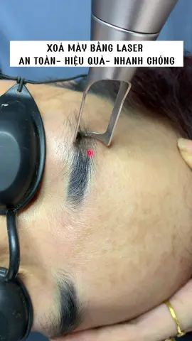 Thay đổi rõ rệt ngay lần đầu tiên nha chị em. Nếu lỡ làm cặp mày xấu rồi thì liên hệ ngay cho em nhé#Minh_Thuý_Spa #bắc_ninh #bắc_giang #quếvobacninh #xoá_sửa_chân_mày #hút_lazer_lông_mày #Valentine2023 #xuhuong 