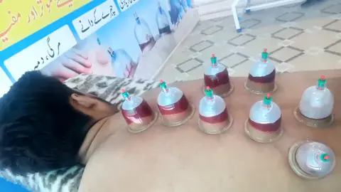 #cupping #sunnah #islam #Fitness #hijama #hijamatherapy #cuppingtherapy #hijamatreatment #tariqjameel #mulanatariqjameel 